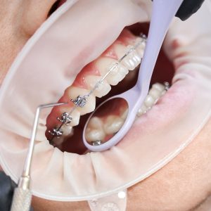best tooth aligners in thanjavur